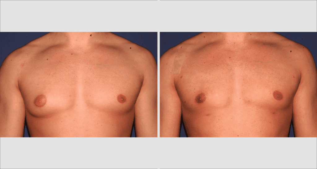 Vorher/Nachher Ergebnis: Bilder Gynaekomastie