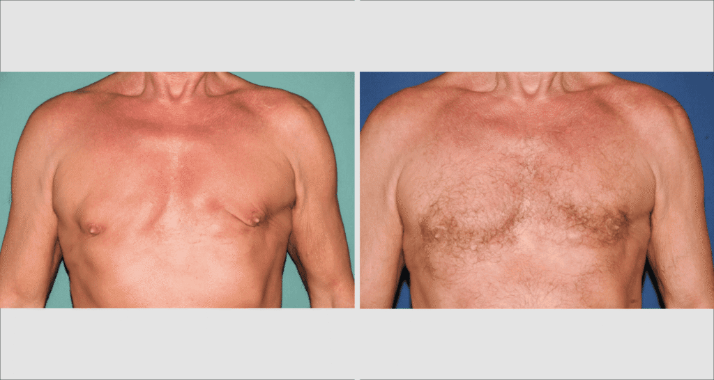 Vorher/Nachher Ergebnis: Bilder Gynaekomastie