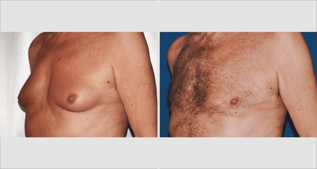 Vorher/Nachher Ergebnis: Bilder Gynaekomastie