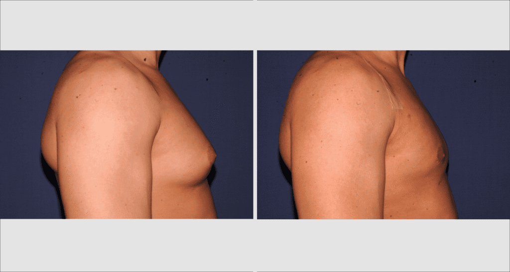 Vorher/Nachher Ergebnis: Bilder Gynaekomastie