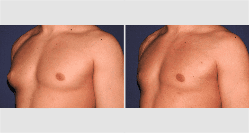 Vorher/Nachher Ergebnis: Bilder Gynaekomastie