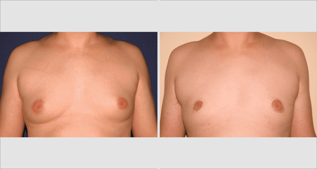 Vorher/Nachher Ergebnis: Bilder Gynaekomastie