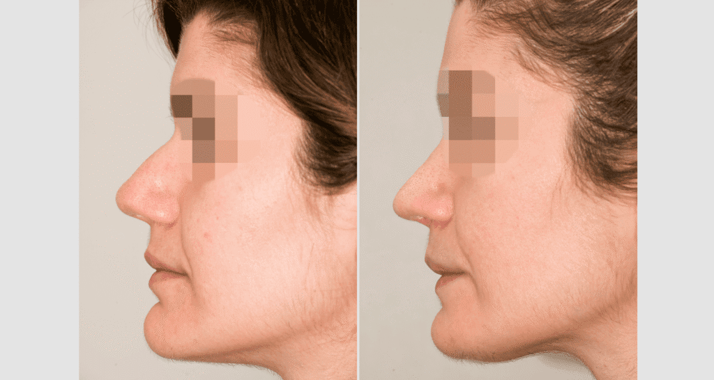 Vorher/Nachher Ergebnis: Bilder Nasenkorrektur