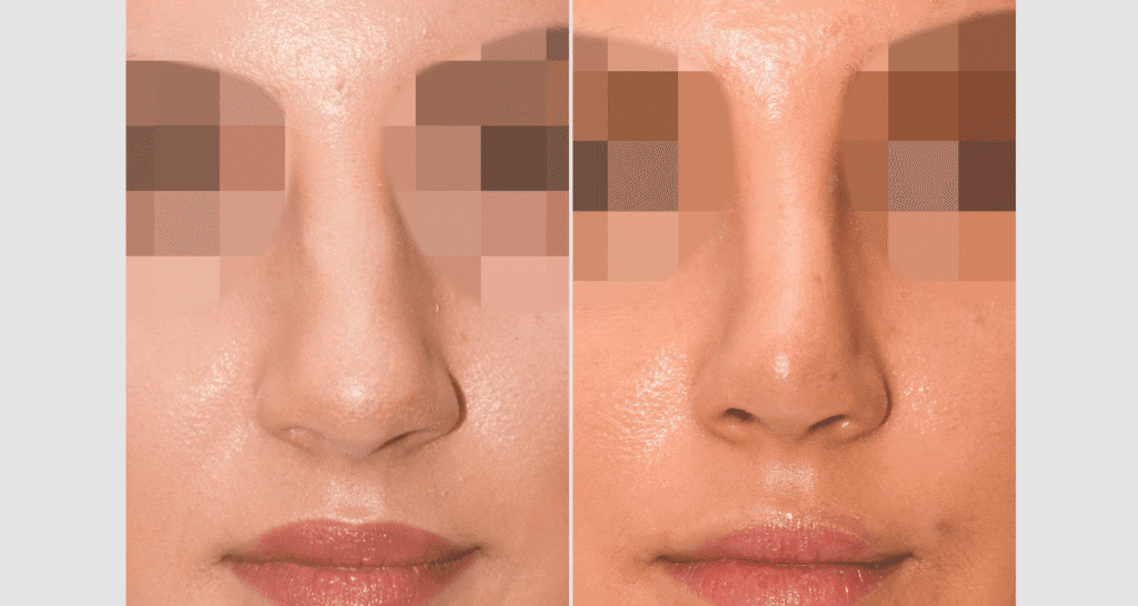 Vorher/Nachher Ergebnis: Bilder Nasenkorrektur