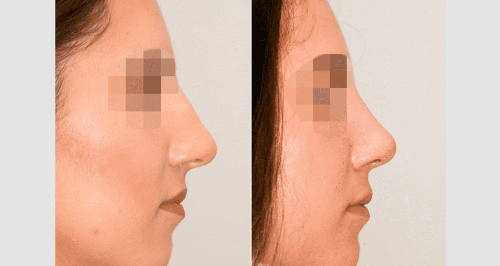 Vorher/Nachher Ergebnis: Bilder Nasenkorrektur
