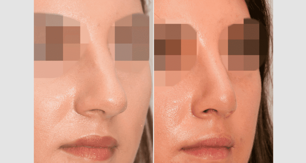 Vorher/Nachher Ergebnis: Bilder Nasenkorrektur
