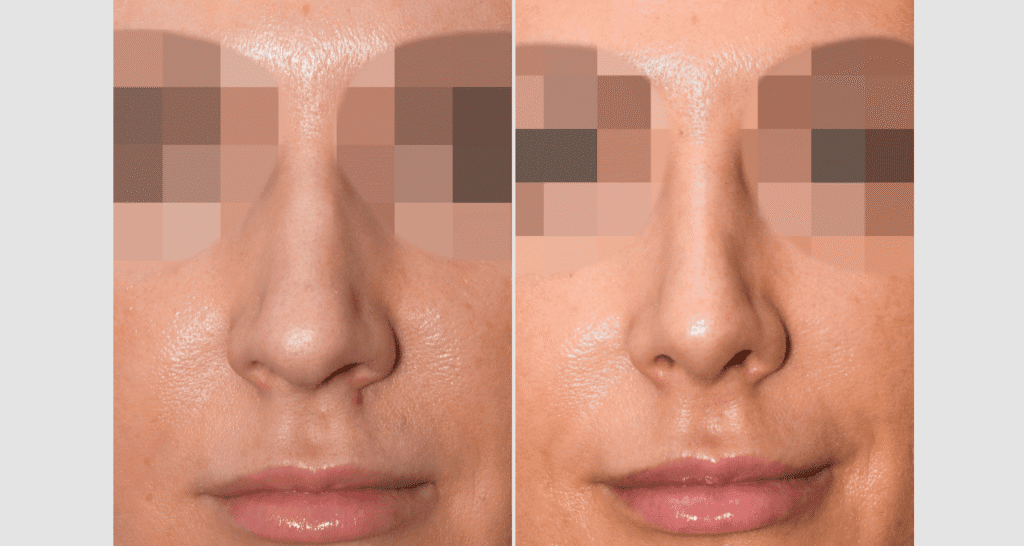 Vorher/Nachher Ergebnis: Bilder Nasenkorrektur