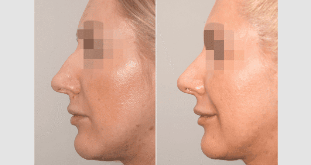 Vorher/Nachher Ergebnis: Bilder Nasenkorrektur