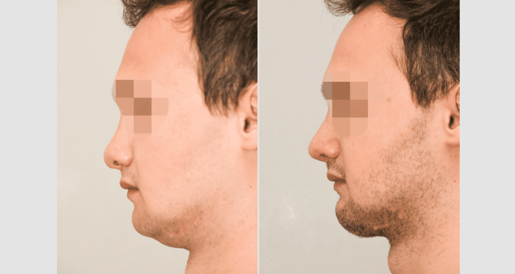 Vorher/Nachher Ergebnis: Bilder Nasenkorrektur