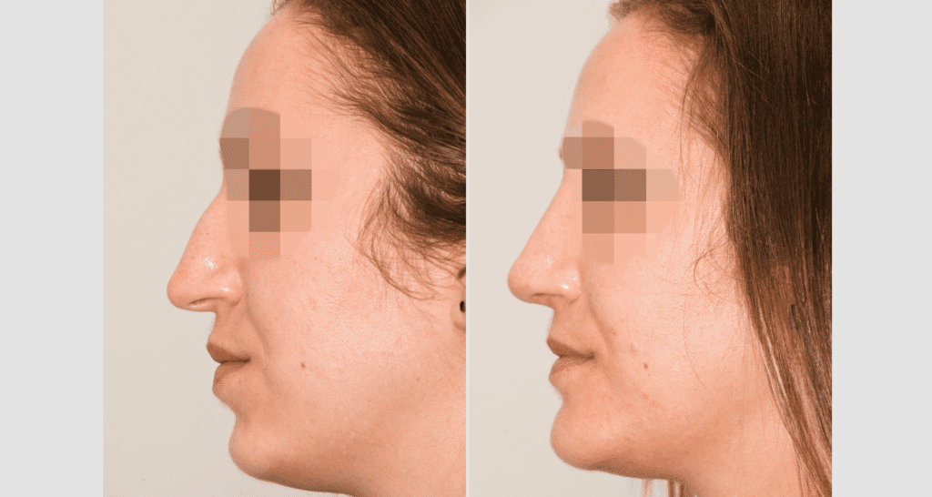 Vorher/Nachher Ergebnis: Bilder Nasenkorrektur