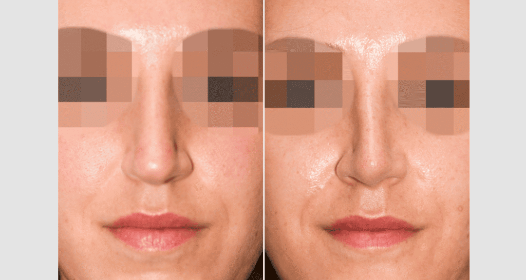 Vorher/Nachher Ergebnis: Bilder Nasenkorrektur