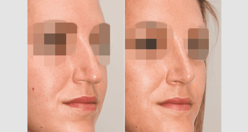 Vorher/Nachher Ergebnis: Bilder Nasenkorrektur