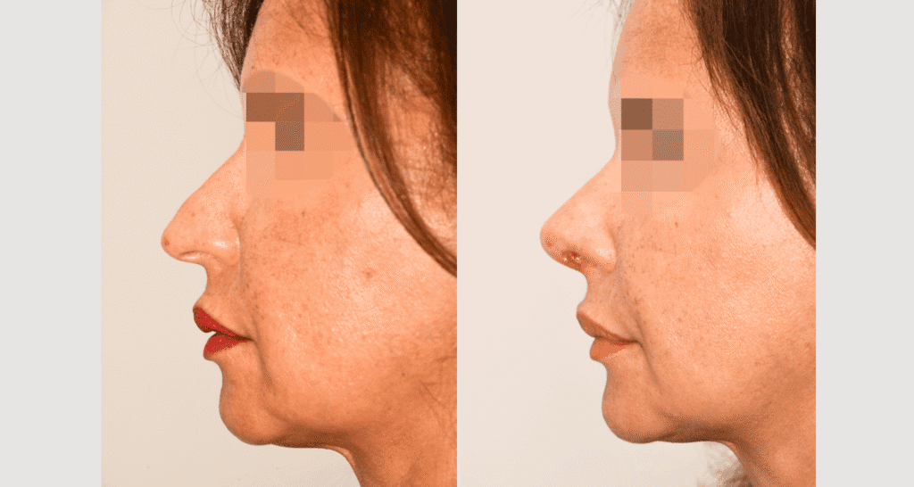 Vorher/Nachher Ergebnis: Bilder Nasenkorrektur