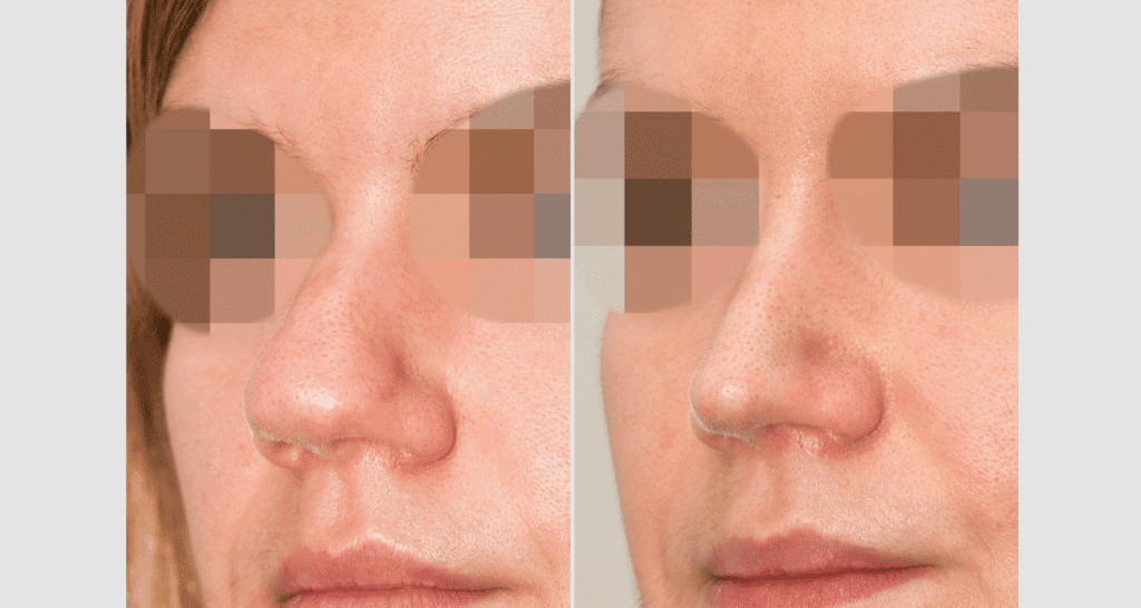 Vorher/Nachher Ergebnis: Bilder Nasenkorrektur