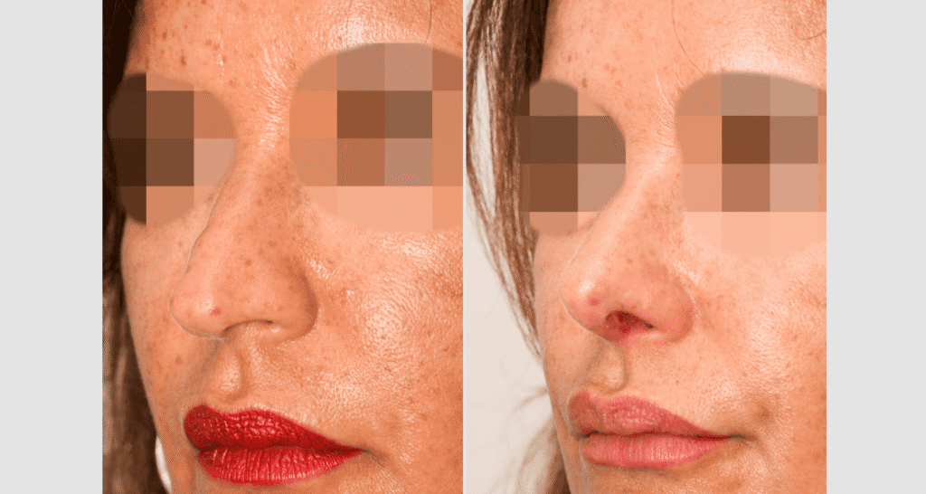 Vorher/Nachher Ergebnis: Bilder Nasenkorrektur