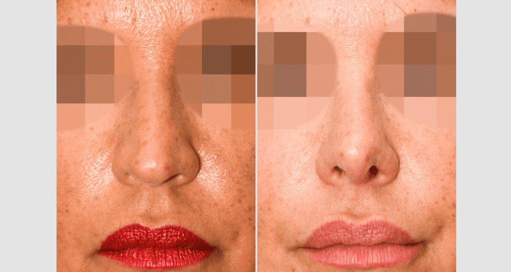 Vorher/Nachher Ergebnis: Bilder Nasenkorrektur