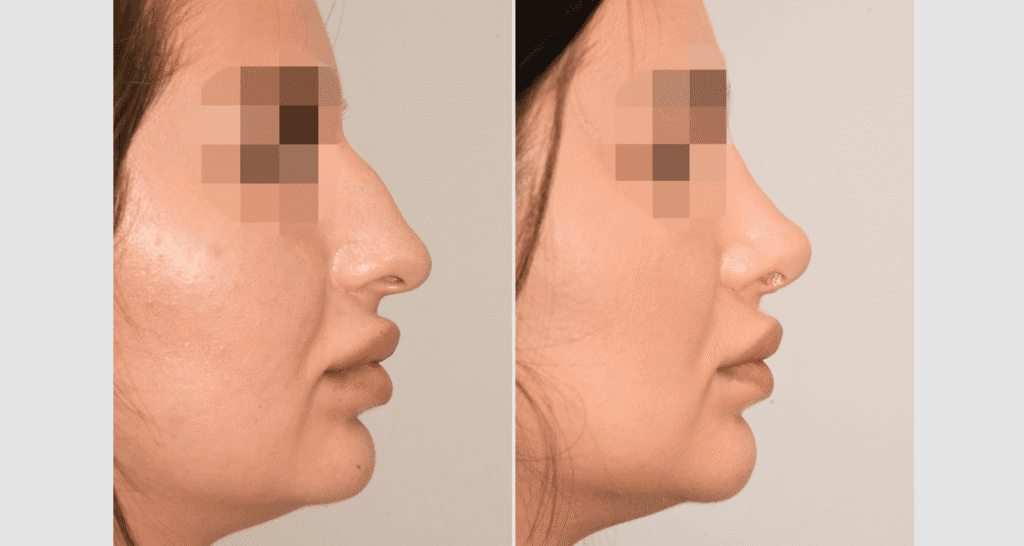 Vorher/Nachher Ergebnis: Bilder Nasenkorrektur