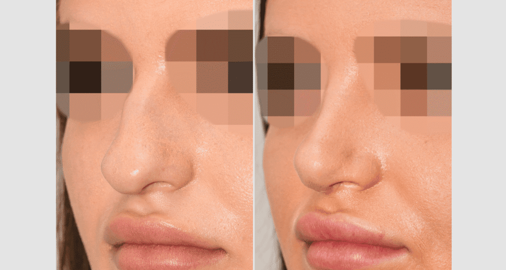 Vorher/Nachher Ergebnis: Bilder Nasenkorrektur