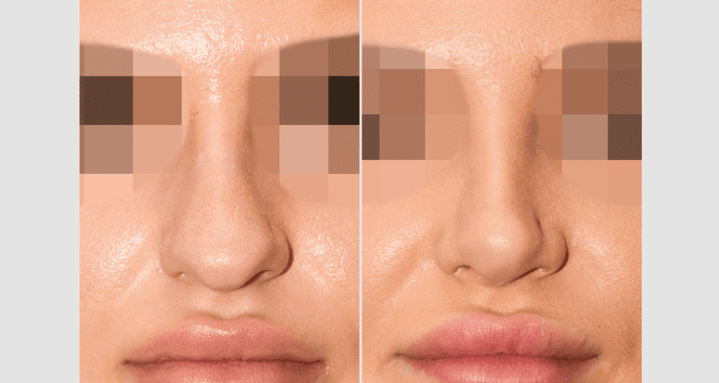 Vorher/Nachher Ergebnis: Bilder Nasenkorrektur