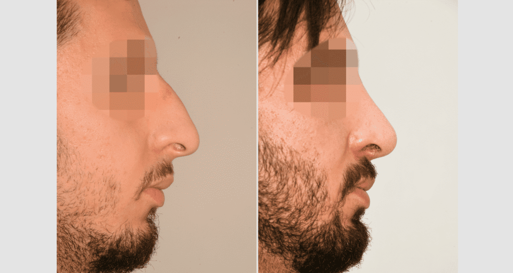 Vorher/Nachher Ergebnis: Bilder Nasenkorrektur