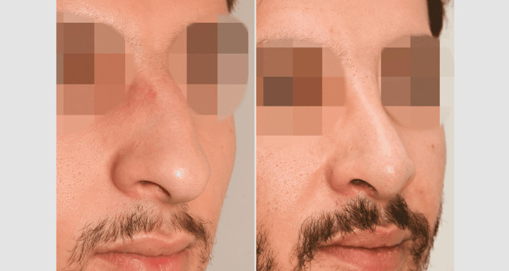 Vorher/Nachher Ergebnis: Bilder Nasenkorrektur