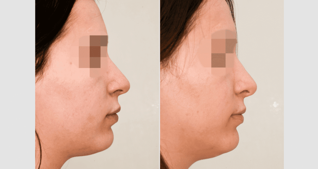 Vorher/Nachher Ergebnis: Bilder Nasenkorrektur