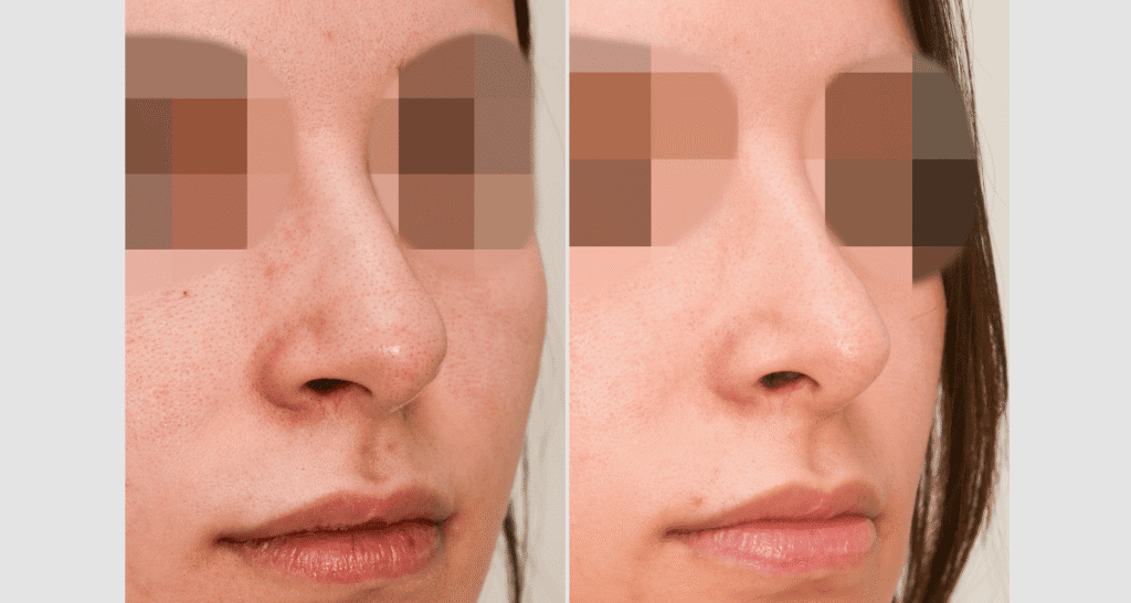 Vorher/Nachher Ergebnis: Bilder Nasenkorrektur