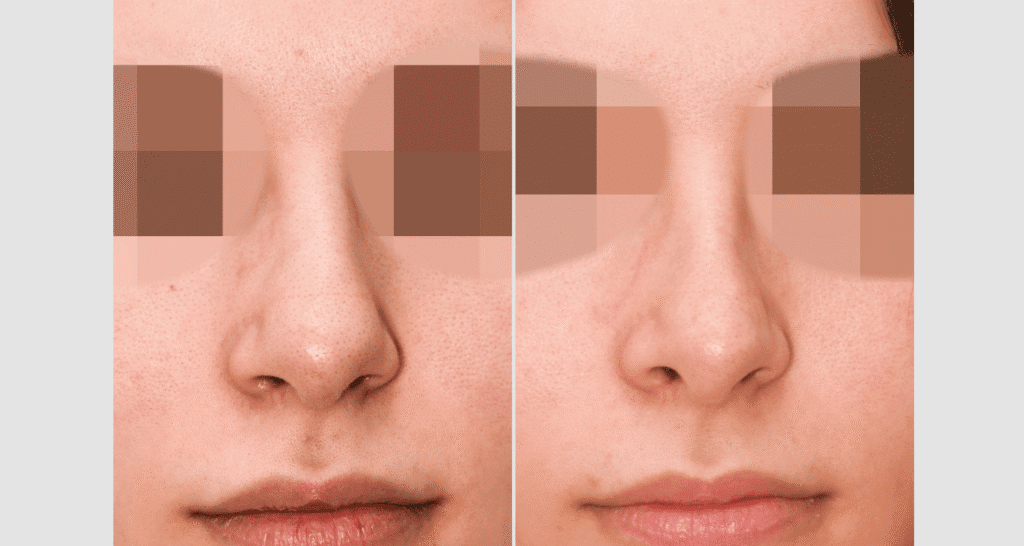 Vorher/Nachher Ergebnis: Bilder Nasenkorrektur