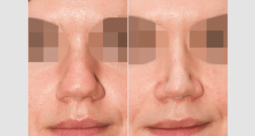 Vorher/Nachher Ergebnis: Bilder Nasenkorrektur