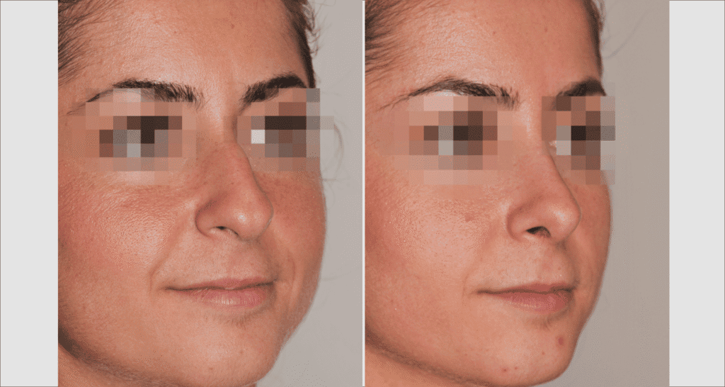 Vorher/Nachher Ergebnis: Bilder Nasenkorrektur