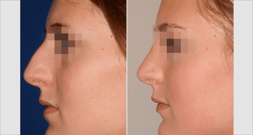 Vorher/Nachher Ergebnis: Bilder Nasenkorrektur