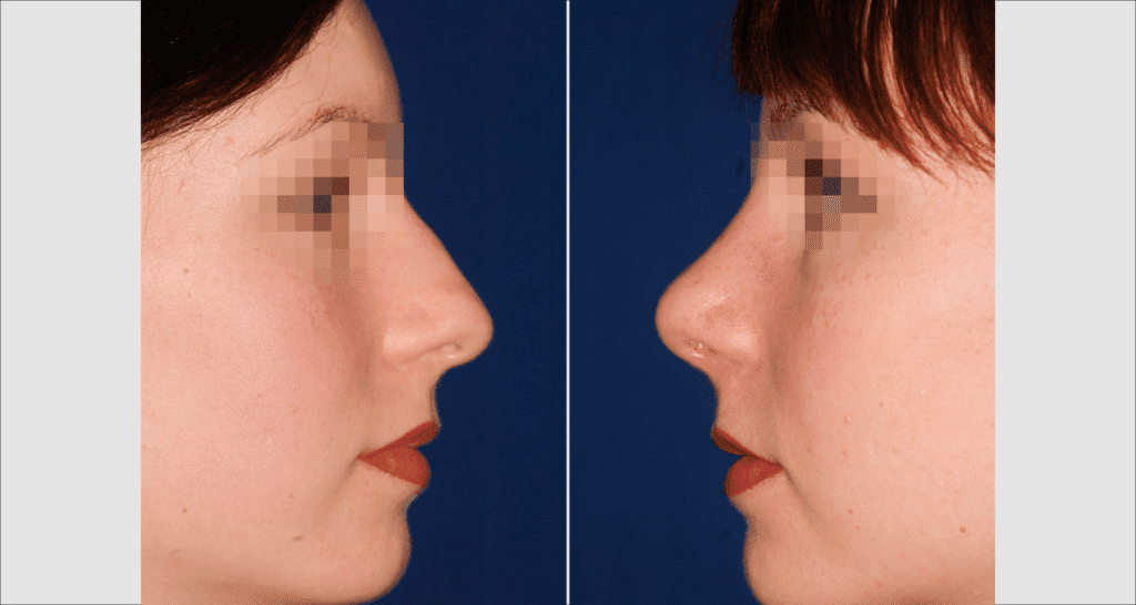 Vorher/Nachher Ergebnis: Bilder Nasenkorrektur