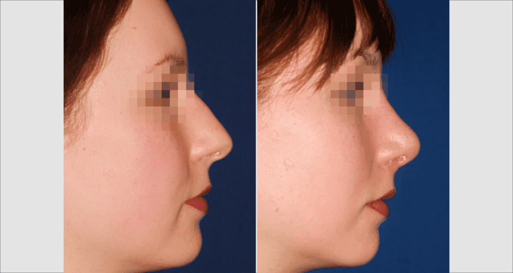 Vorher/Nachher Ergebnis: Bilder Nasenkorrektur