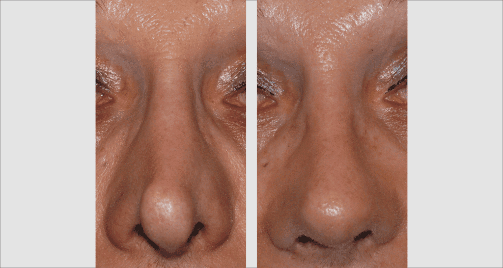 Vorher/Nachher Ergebnis: Bilder Nasenkorrektur