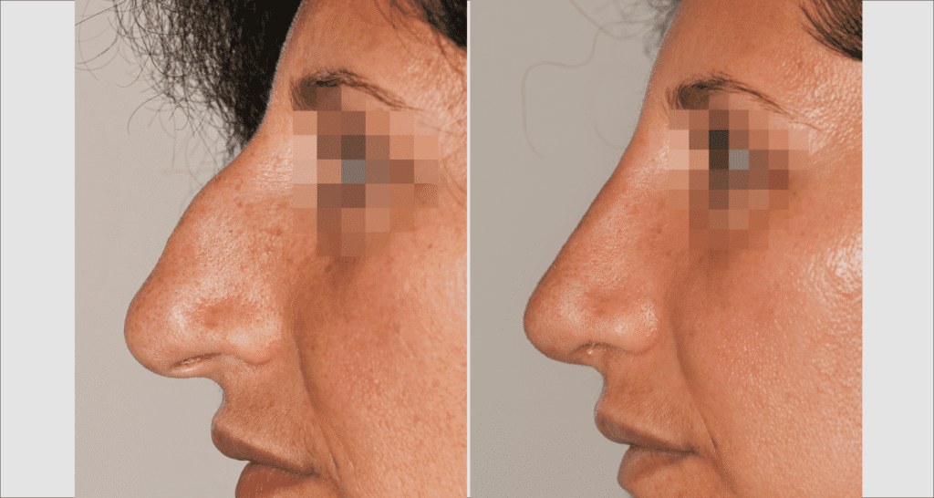 Vorher/Nachher Ergebnis: Bilder Nasenkorrektur