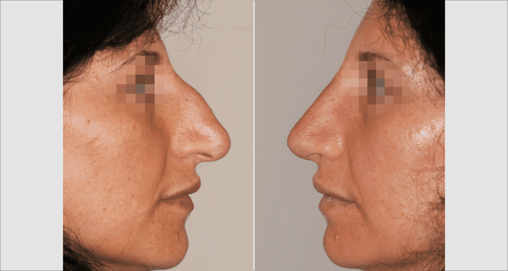 Vorher/Nachher Ergebnis: Bilder Nasenkorrektur
