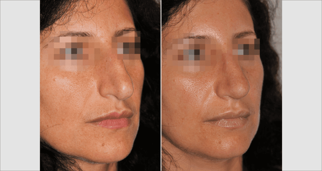 Vorher/Nachher Ergebnis: Bilder Nasenkorrektur