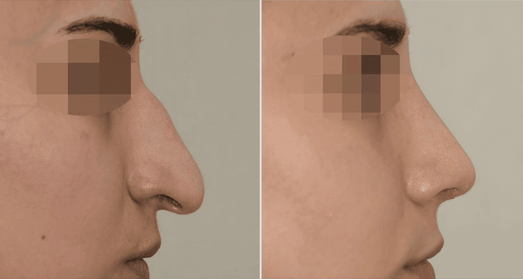 Vorher/Nachher Ergebnis: Bilder Nasenkorrektur
