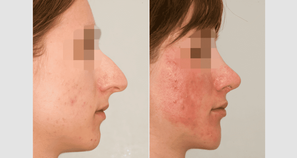 Vorher/Nachher Ergebnis: Bilder Nasenkorrektur