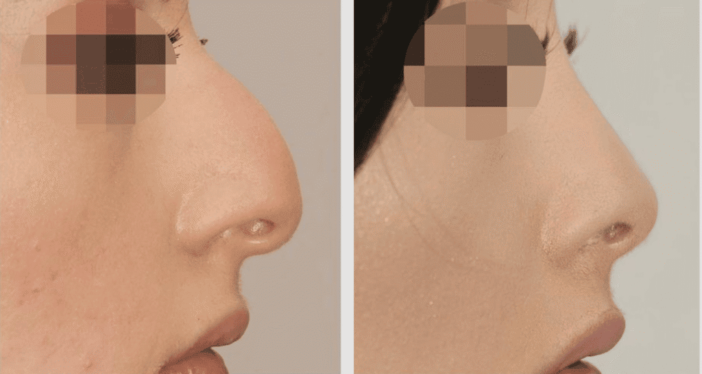 Vorher/Nachher Ergebnis: Bilder Nasenkorrektur