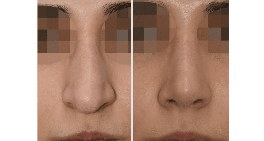 Vorher/Nachher Ergebnis: Bilder Nasenkorrektur
