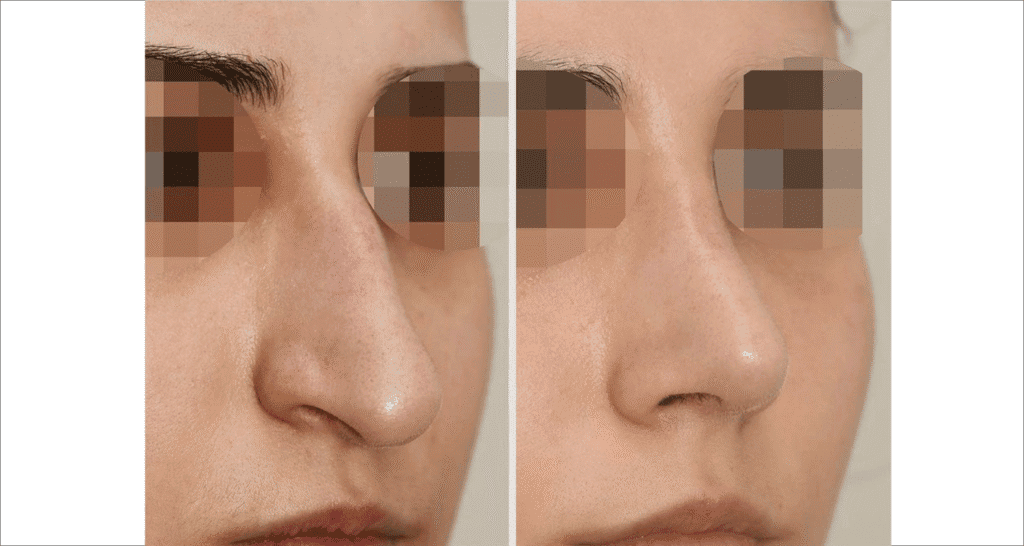 Vorher/Nachher Ergebnis: Bilder Nasenkorrektur