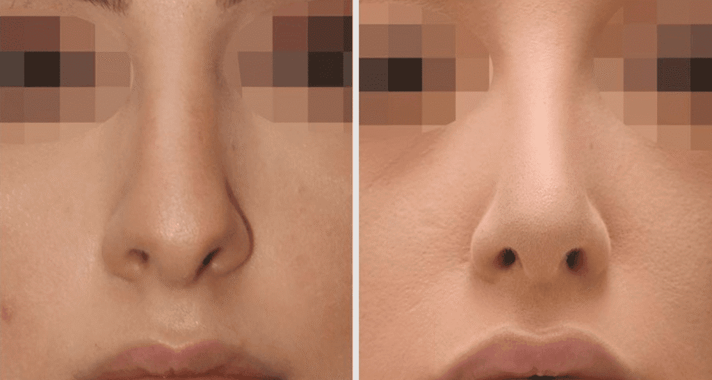 Vorher/Nachher Ergebnis: Bilder Nasenkorrektur