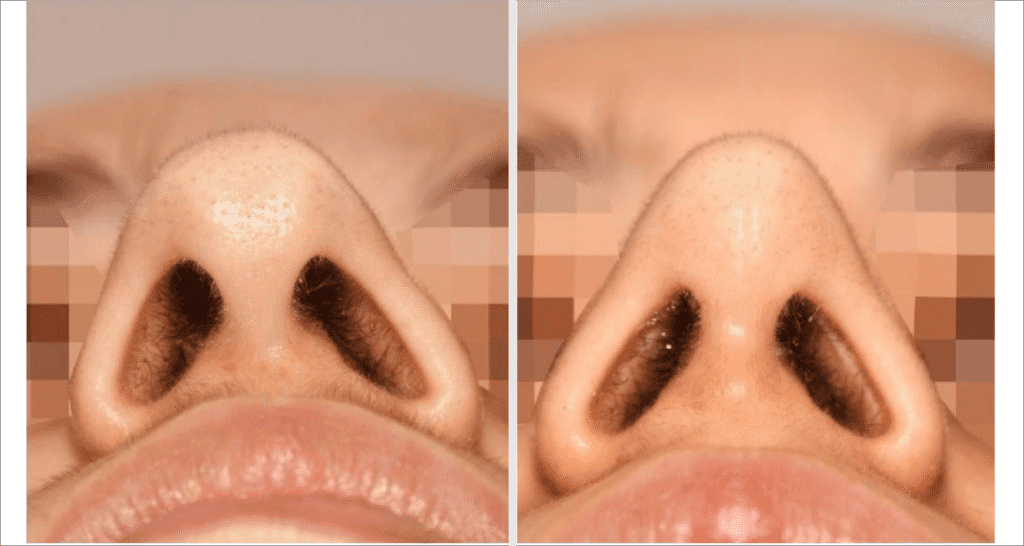 Vorher/Nachher Ergebnis: Bilder Nasenkorrektur