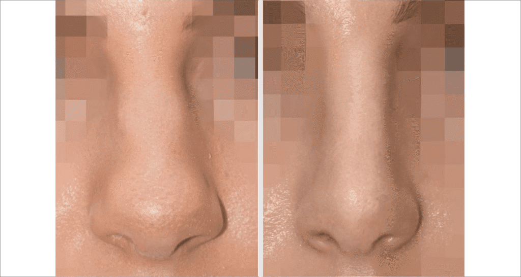 Vorher/Nachher Ergebnis: Bilder Nasenkorrektur