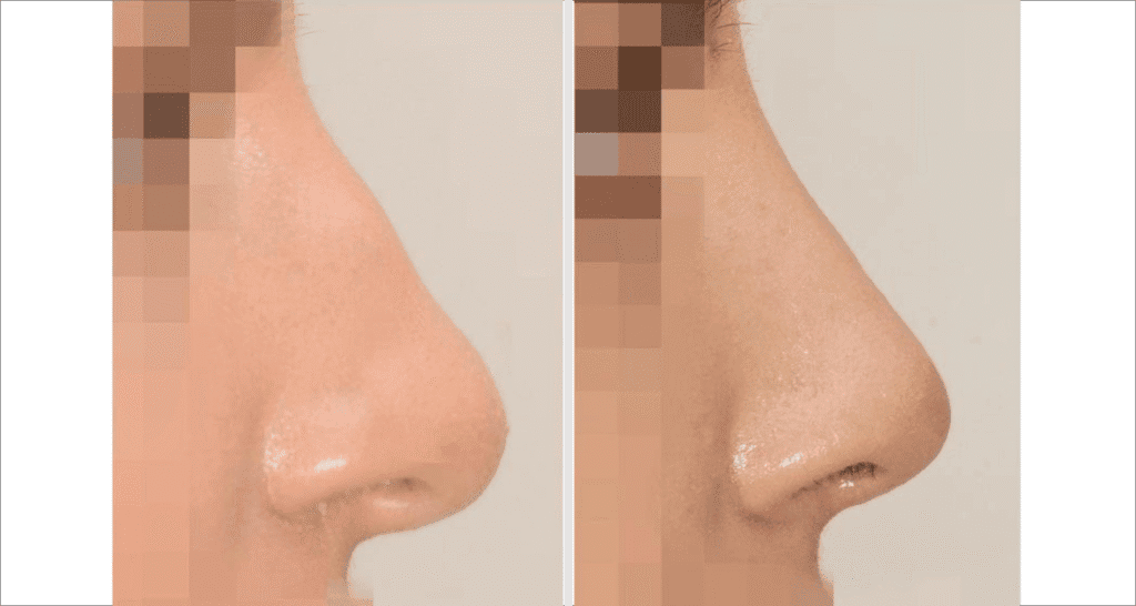 Vorher/Nachher Ergebnis: Bilder Nasenkorrektur