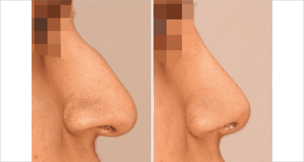 Vorher/Nachher Ergebnis: Bilder Nasenkorrektur