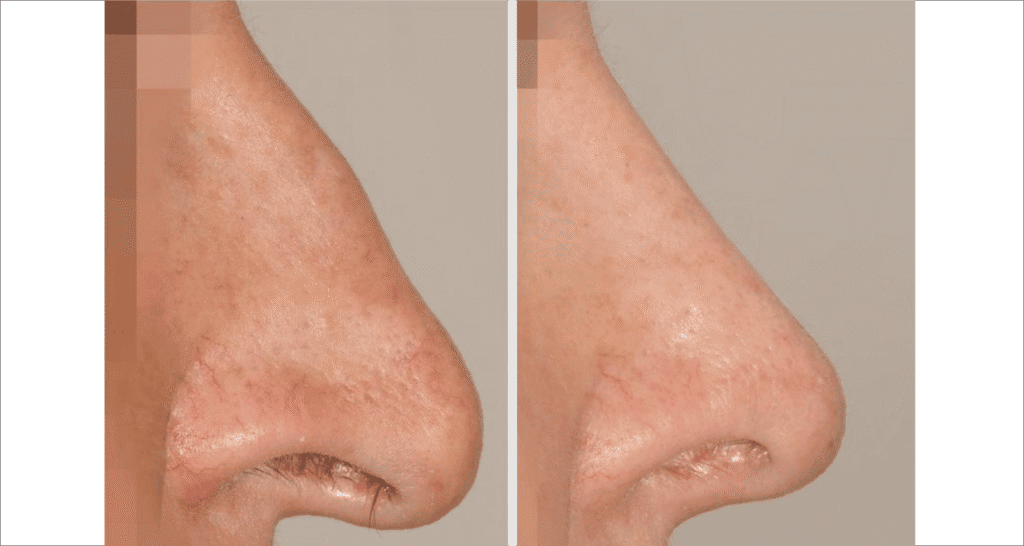 Vorher/Nachher Ergebnis: Bilder Nasenkorrektur