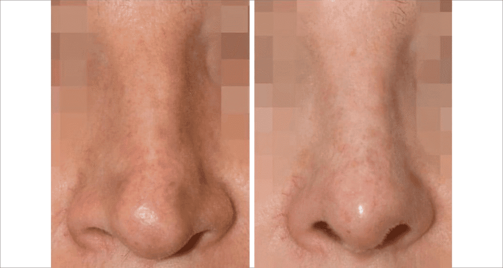 Vorher/Nachher Ergebnis: Bilder Nasenkorrektur