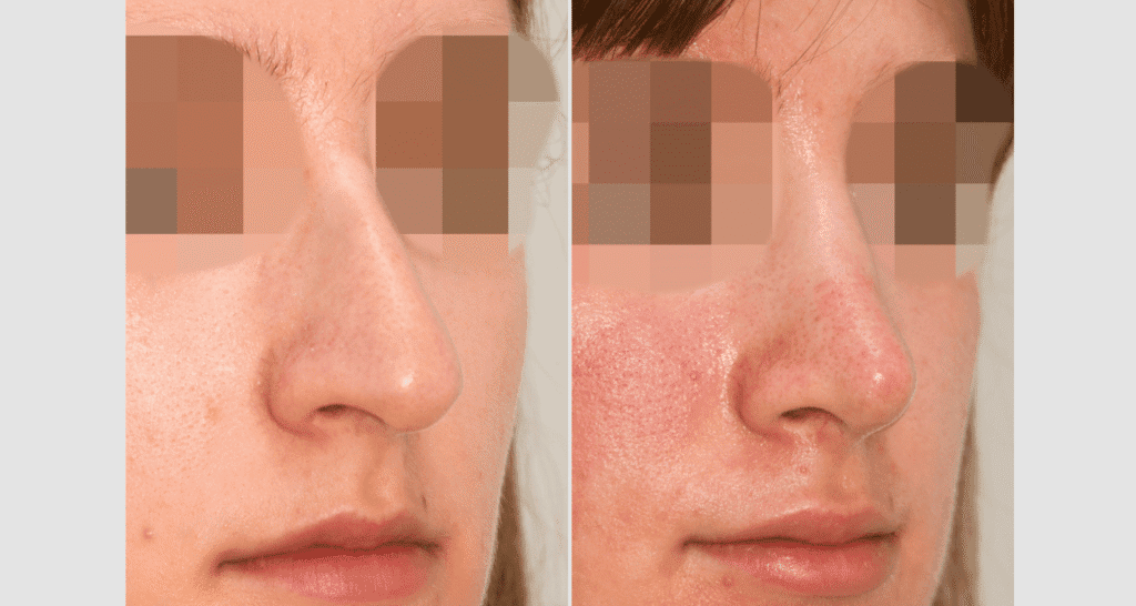 Vorher/Nachher Ergebnis: Bilder Nasenkorrektur